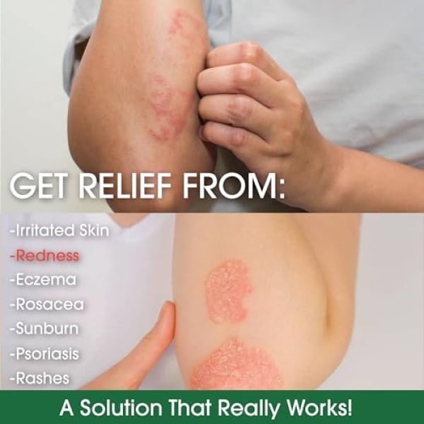 Amazing Aloe Vera Eczema and Psoriasis Cream with Manuka Honey by Green Leaf Naturals - 4 oz - Image 5